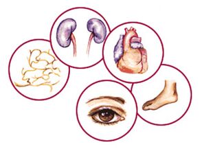Organe, zu denen die Komplikationen von Diabetes mellitus